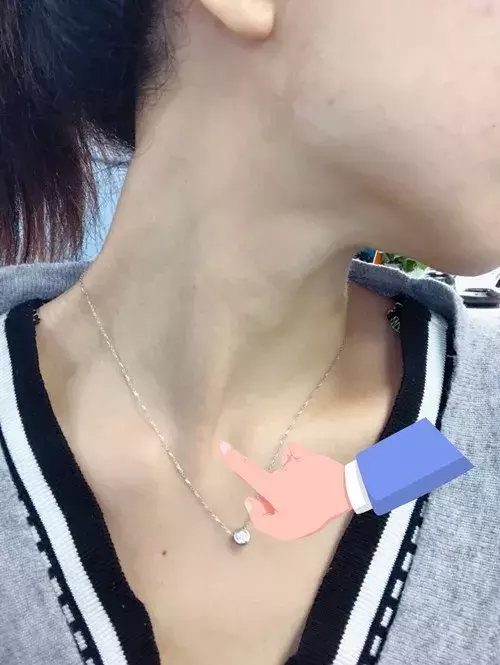 歪脖子,宝宝越小治愈率越高,图解从诊断到治疗方法等你来拿