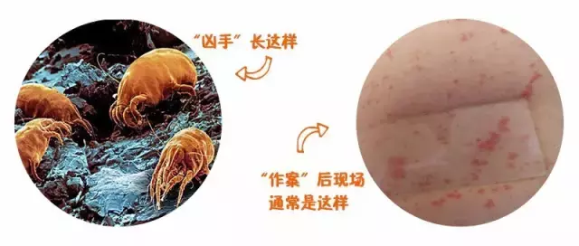 蚊虫咬一口,宝宝身上红肿一大片,医生说,夏季警惕虫咬性皮炎