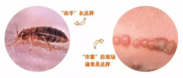 蚊虫咬一口,宝宝身上红肿一大片,医生说,夏季警惕虫咬性皮炎