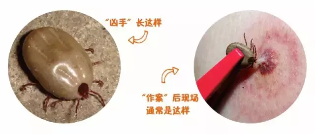 蚊虫咬一口,宝宝身上红肿一大片,医生说,夏季警惕虫咬性皮炎