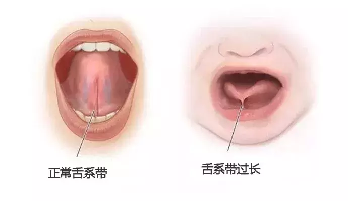 婴儿唇系带标准图片（别让这两种系带影响孩子的口腔健康）