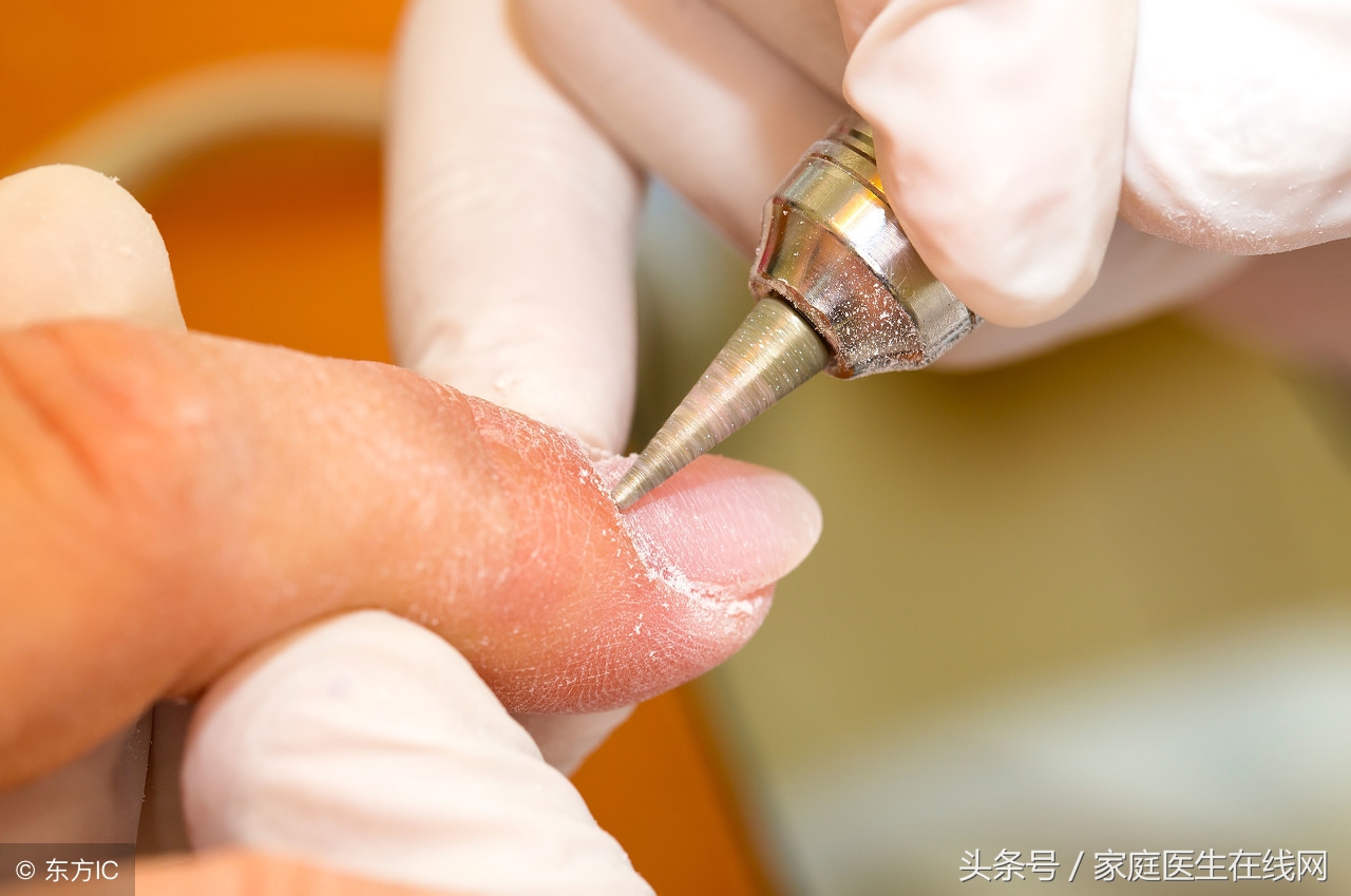 指甲凹陷就是生病了？医生：别胡乱猜想，可能是这7个原因引起！