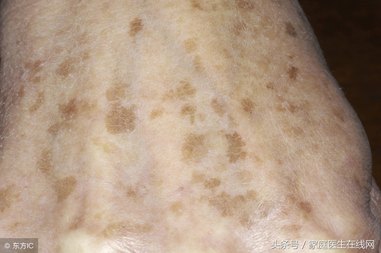 为什么年纪轻轻也会长老年斑?这4点是主因,别被蒙在鼓里