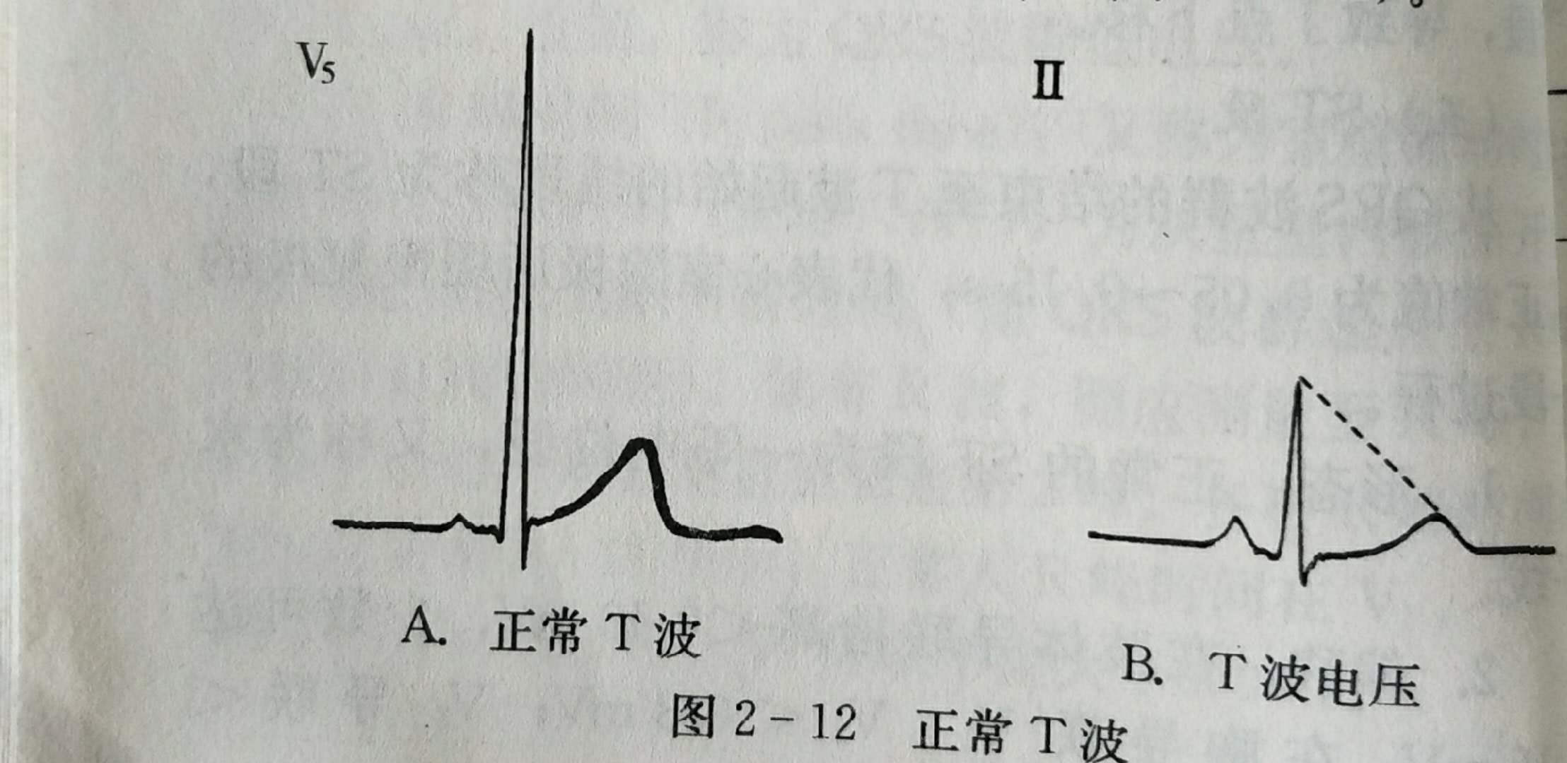 心电图多少算正常（心电图多少算正常图片）-第6张图片-华展网