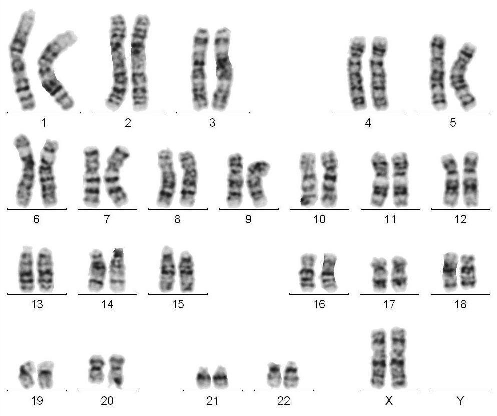 孕前检查染色体图片