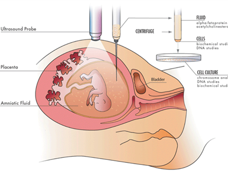 产前检查，不容忽视的染色体异常