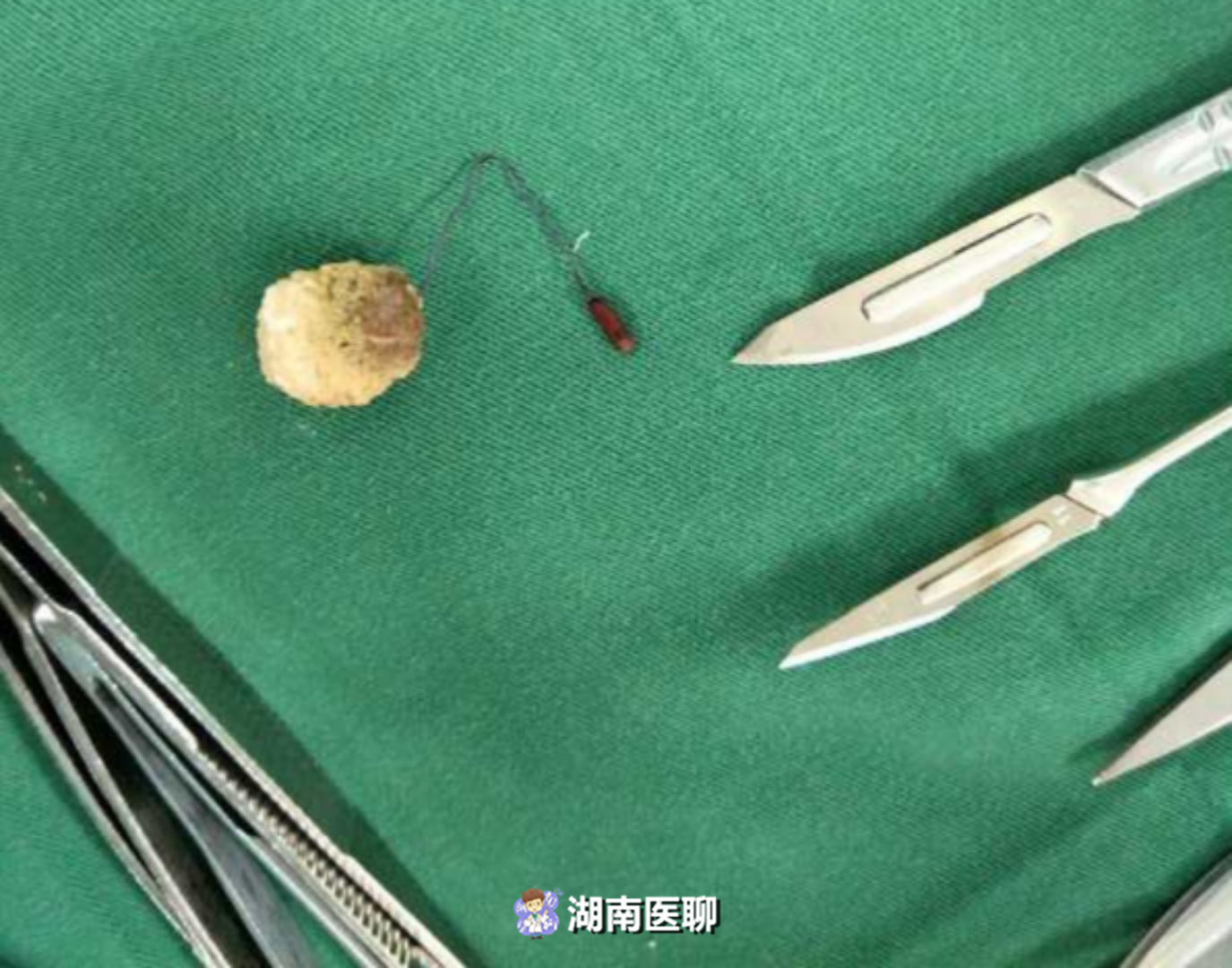 爱母环多少钱(女子节育器9年后不见踪影) - 价格百科