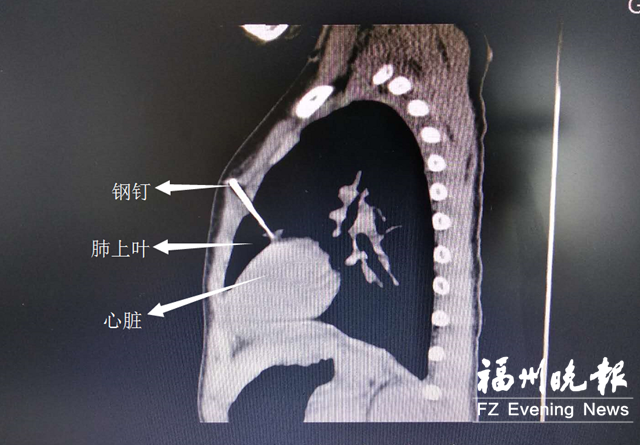 男童误扣扳机钢钉射入左胸 别让孩子靠近装修场所