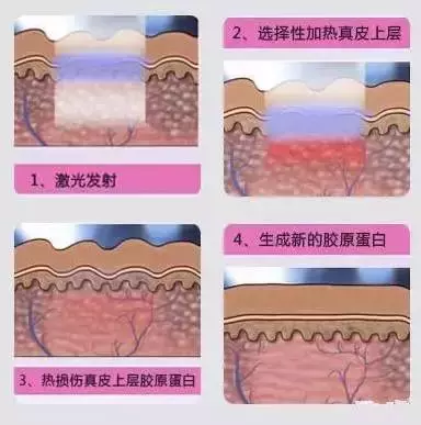 科普|针对痘痘肌、毛孔粗大,黑头粉刺的医美项目有哪些呢?