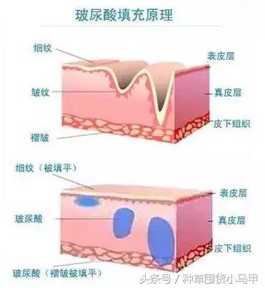 王菲500万天价打的童颜针，真的可以返老还童吗？