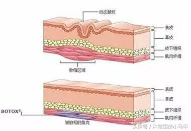 王菲500万天价打的童颜针，真的可以返老还童吗？