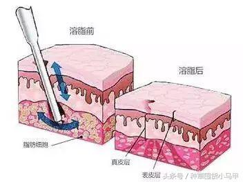 王菲500万天价打的童颜针，真的可以返老还童吗？