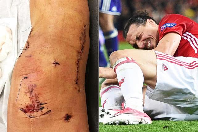曼联大将赛后晒出七道伤疤(伊布展示为曼联踢球重伤残留吓人伤痕！曼联的「软蛋」都该向他学)