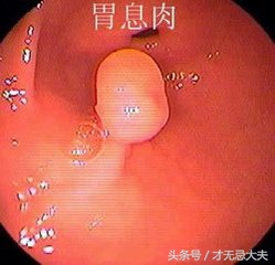 胃息肉可怕吗？它有多大几率癌变？浅谈胃息肉的治疗和预防