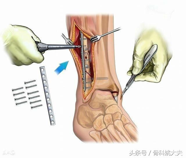 手术装入的钢板必须取吗？