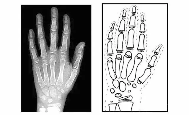 了解孩子发育的好不好，测测骨龄就知道