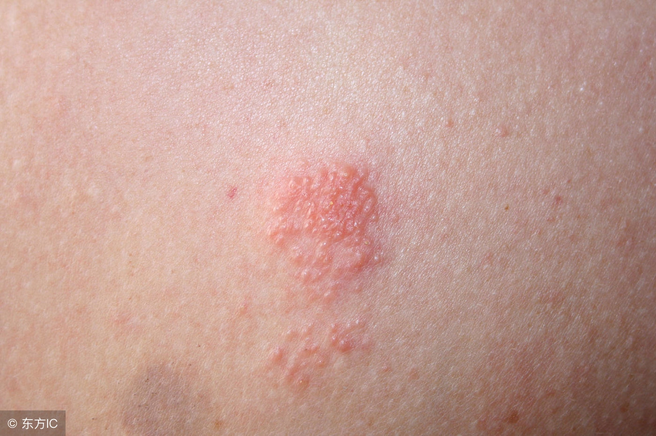 什么是阴囊疱疹病毒感染,阴囊长疱疹什么原因-友友