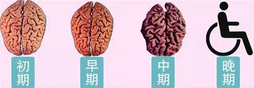 何为小脑萎缩?是什么原因引起的?应该怎么治疗?