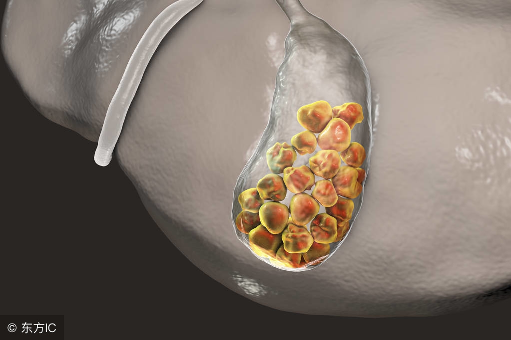 有胆结石怎么办（体检发现胆结石怎么办？这4个治疗方法可对症选择，不必过于担心）