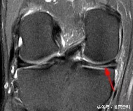 哪些nba球星半月板缝合过(半月板的伤痛，让NBA球星备受折磨，骨科医生揭开治疗真相)