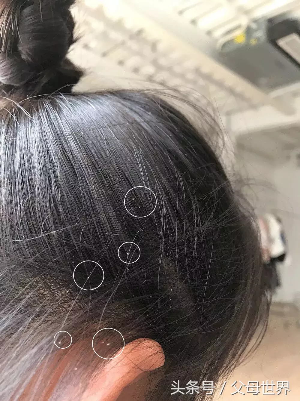 天天给女儿洗头,竟然还长了满头虱子!原因你也忽略过……