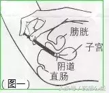 「每日一药」克霉唑栓(友南)