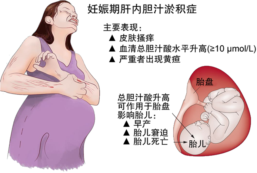 孕期皮肤瘙痒、持续性呕吐、黄疸，警惕肝功能异常！