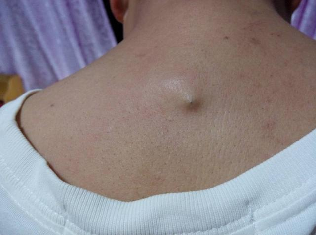 身上有螨虫的症状图片(后背出现4个变化) - 赤虎壹号