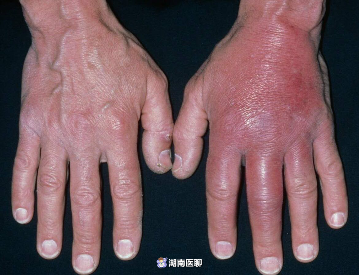 男子被小小鱼刺扎伤,6天后感染化脓红肿像"馒头"?