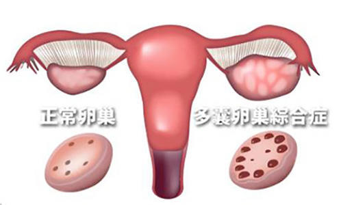 吃达英超过六个月会怎么样(多囊卵巢综合症吃达英35能治好吗？)