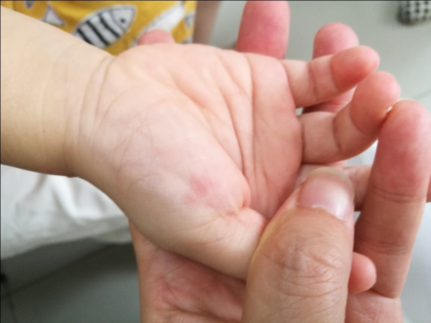 婴儿胞疹症状图片(才21个月大的宝宝)-幼儿百科-魔术铺