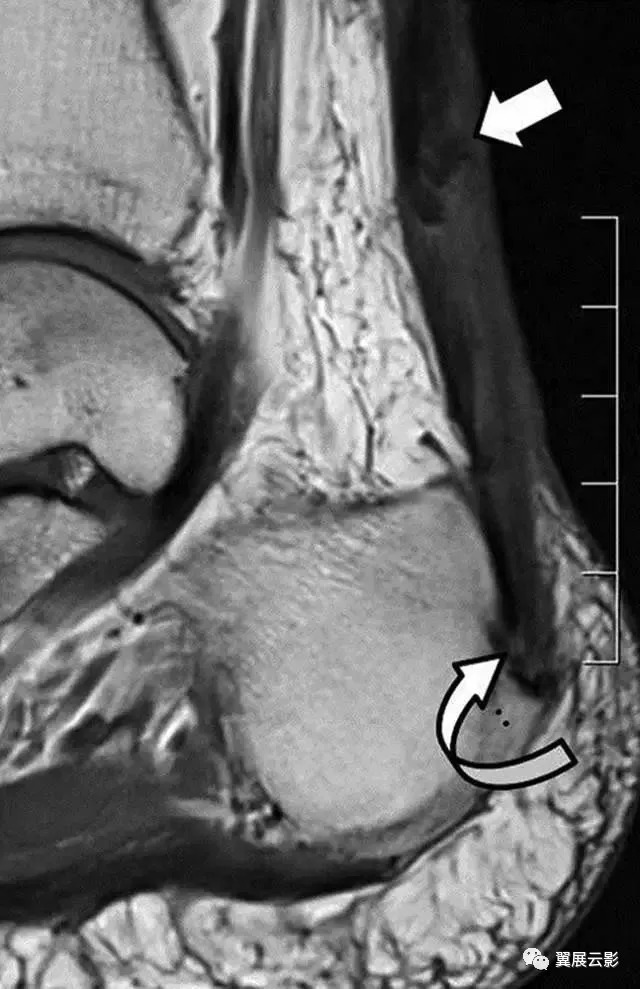 5种医学影像上最容易误诊漏诊的跟骨撕裂：大多与创伤有关