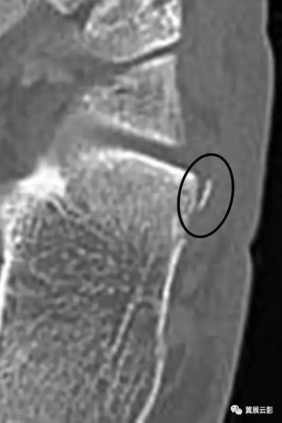 5种医学影像上最容易误诊漏诊的跟骨撕裂：大多与创伤有关