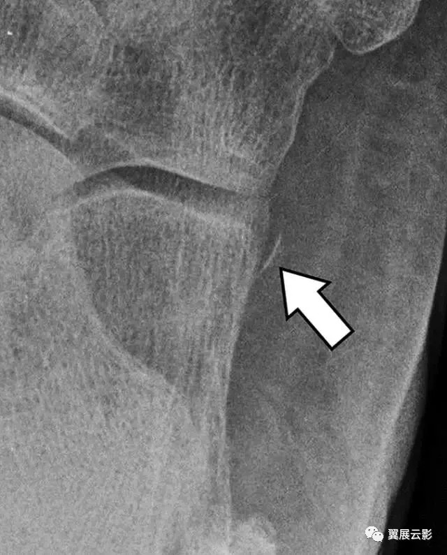 5种医学影像上最容易误诊漏诊的跟骨撕裂：大多与创伤有关