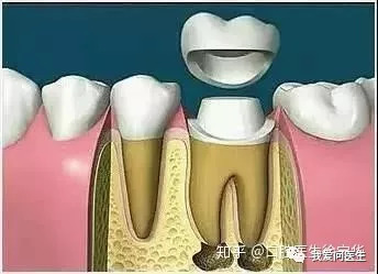 预告 9月20日 种牙别被忽悠