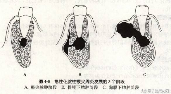 全國愛牙日|牙齦膿包怎麼辦?