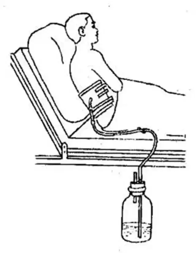 这12类管道护理最佳技法，不是每个护士都知道！
