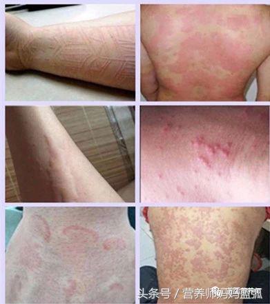 胆碱能性荨麻疹图片(每5个人就有1个患寻麻疹) - 赤虎壹号