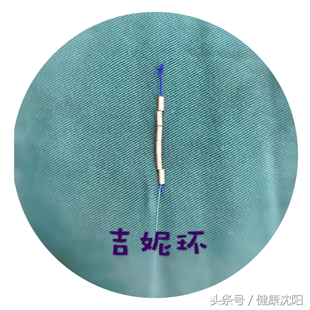 各种节育环的种类图片介绍(健康科普堂) - 赤虎壹号