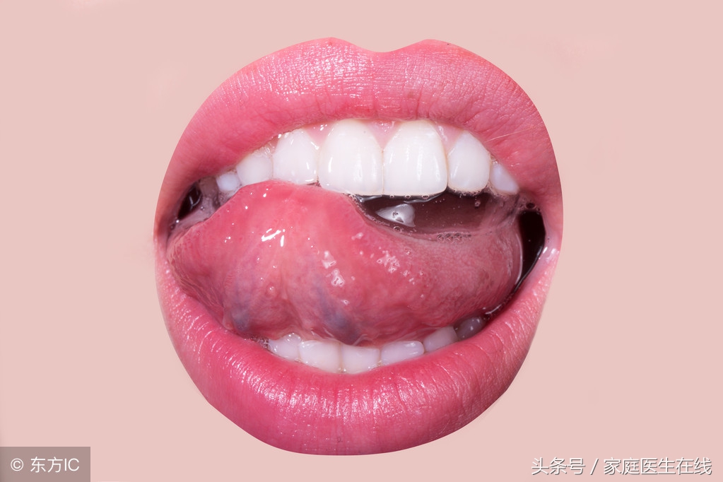 舌头起泡疼痛难忍怎么办？快速缓解舌部水泡不适的方法