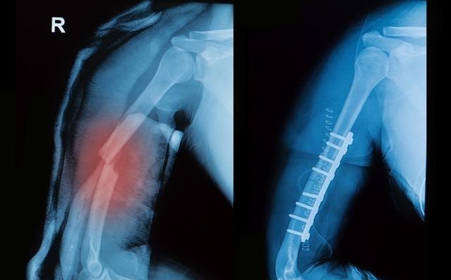 手指被篮球砸了怎么判断骨折（受伤后嫌麻烦又不想跑医院，如何知道自己是不是骨折了呢？）-趣拿体育