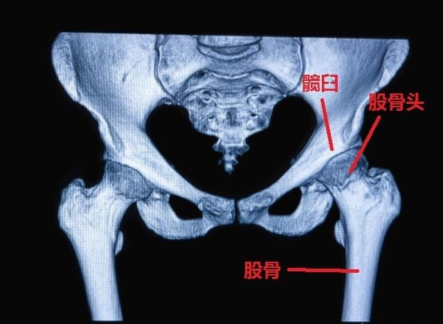 孩子髋关节发育的一系列相关疾病,其中包括髋臼和股骨近端的发育异常