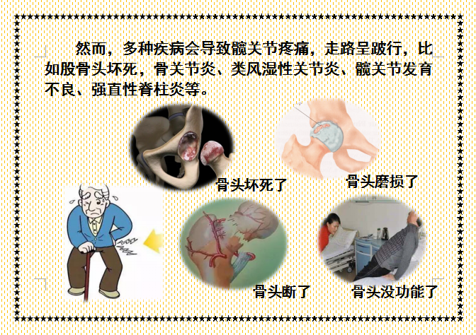 护士二郎腿图片.(人工髋关节置换术后体位指导画册，三甲医院护士教您如何护理！)