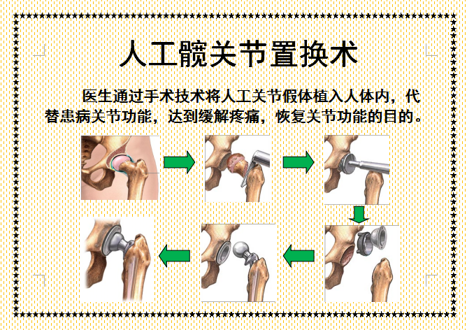 护士二郎腿图片.(人工髋关节置换术后体位指导画册，三甲医院护士教您如何护理！)