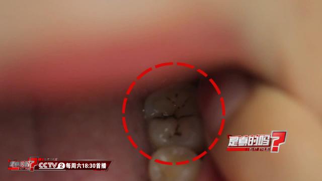 大牙有黑色的缝隙那是什么样子（大牙有黑色的缝隙那是什么）