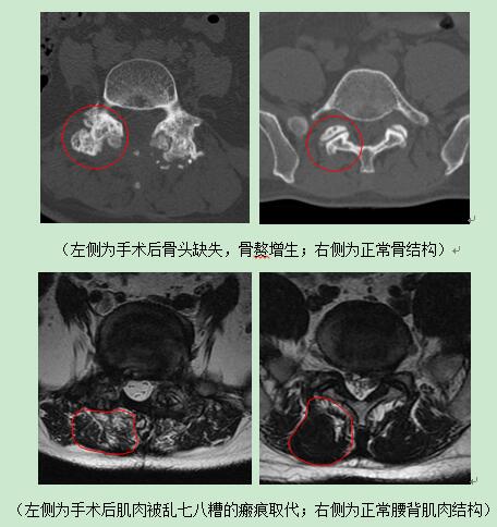 骨科医生给脊柱做了个翻修术 错位腰椎归队了