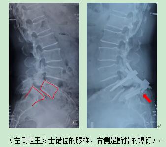 骨科医生给脊柱做了个翻修术 错位腰椎归队了