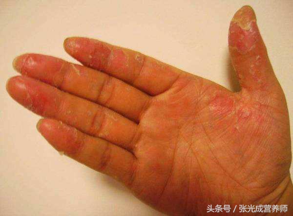 手脱皮严重，吃什么食物能改善并恢复如初？