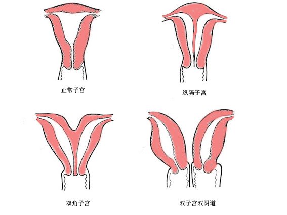 我們正常的子宮是隻有一個宮腔,宮腔有三個門,前門是子宮頸內口,兩個