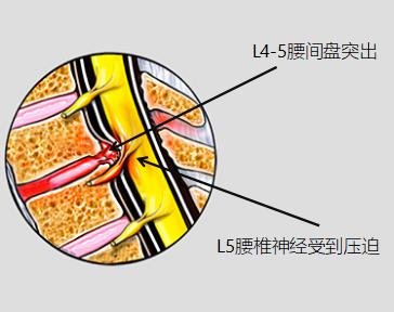 严不严重？要不要手术？几分钟教你看懂腰椎的检查报告！